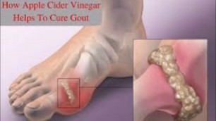 'Foods To Prevent Gout - Uric Acid Prevent Joint Problems'