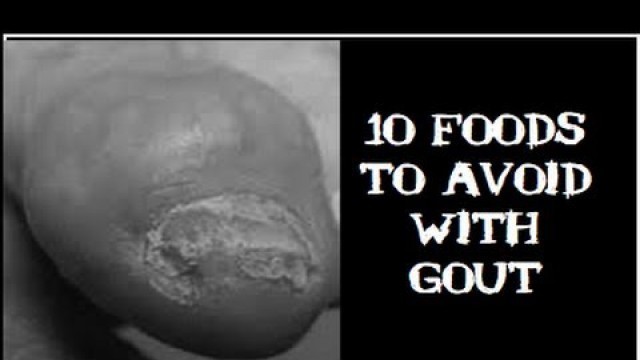 '10 Foods To Avoid With Gout When You Are On A Uric Acid Diet'